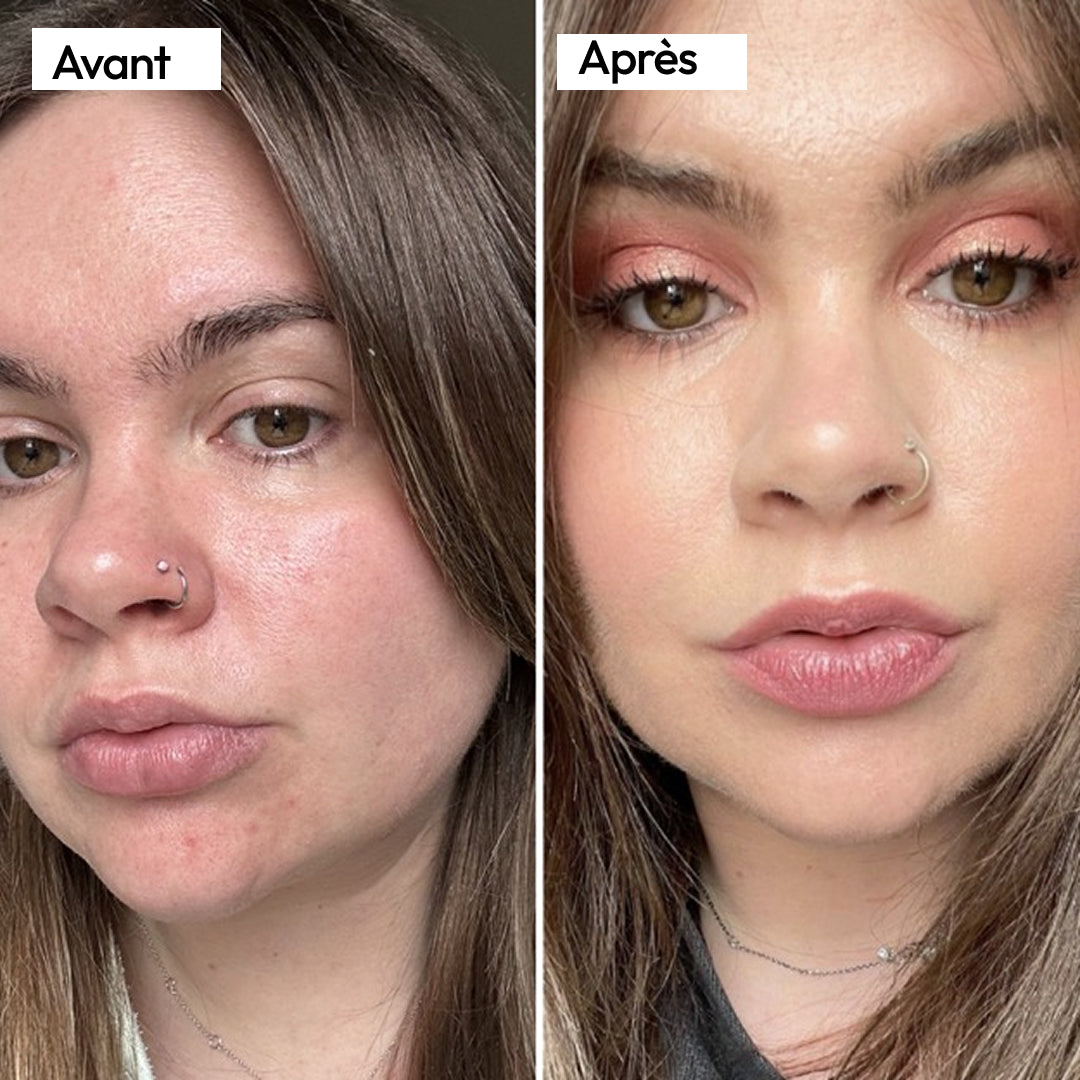 J'ai 34 ans et ma rosacée semble enfin calme et claire