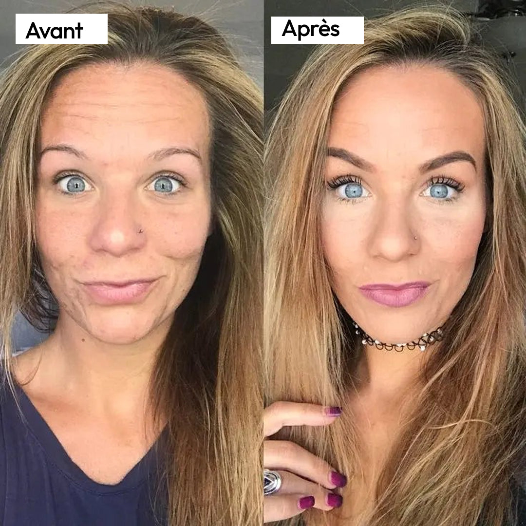 Linda, 43 ans, a cessé de lutter contre sa rosacée